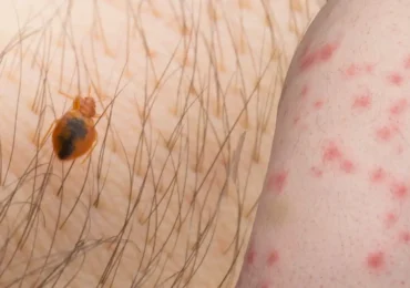Bed bug bites how to identify and treatment